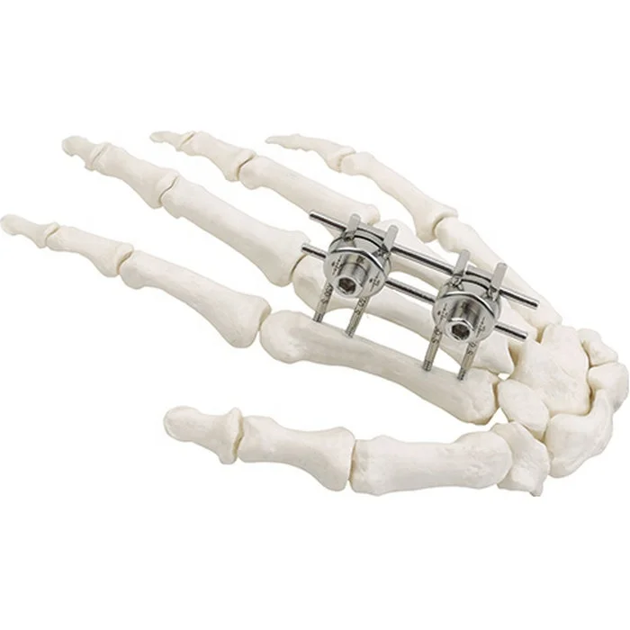 جودة مضمونة مثبت خارجي نصف دائري جراحي