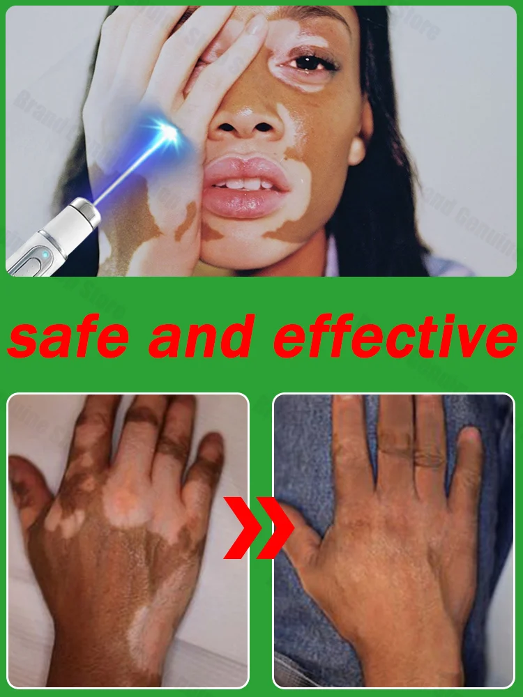 

Treatment vitiligo