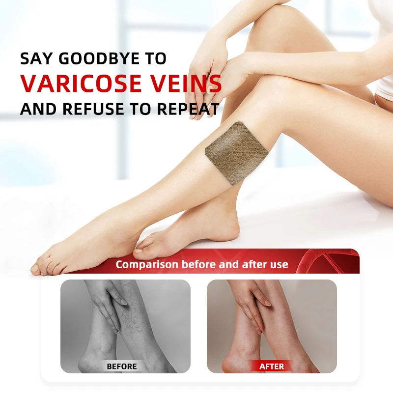 6pcs Varicose Veins Patch Vasculitis Phlebitis Spider Cream Varicosity Angiitis Ointmnet Removal Herbal Medical Plaster