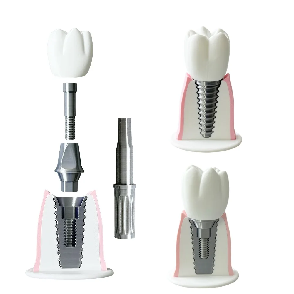 Dental Tooth Implant Anatomy Teaching Model Removable Crown Bridge Restoration Demonstration Model for Clinic Education Study