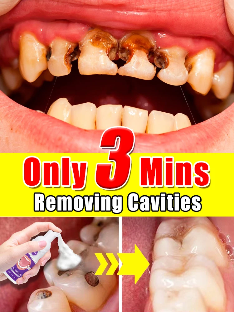 

Solves caries and tooth decay problem