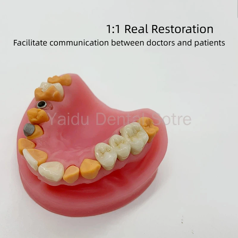 1PC Silicone Dental Restoration Mold Display Inlay Veneer Porcelain Bridge Dental Implant Abutment Model for Dental Lab Training