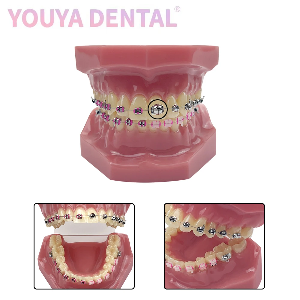 Dental Spherical Self-Ligating Bracket Orthodontic Tooth Model Half Metal Half Ceramic Braces Comparison Model Dentist Teaching