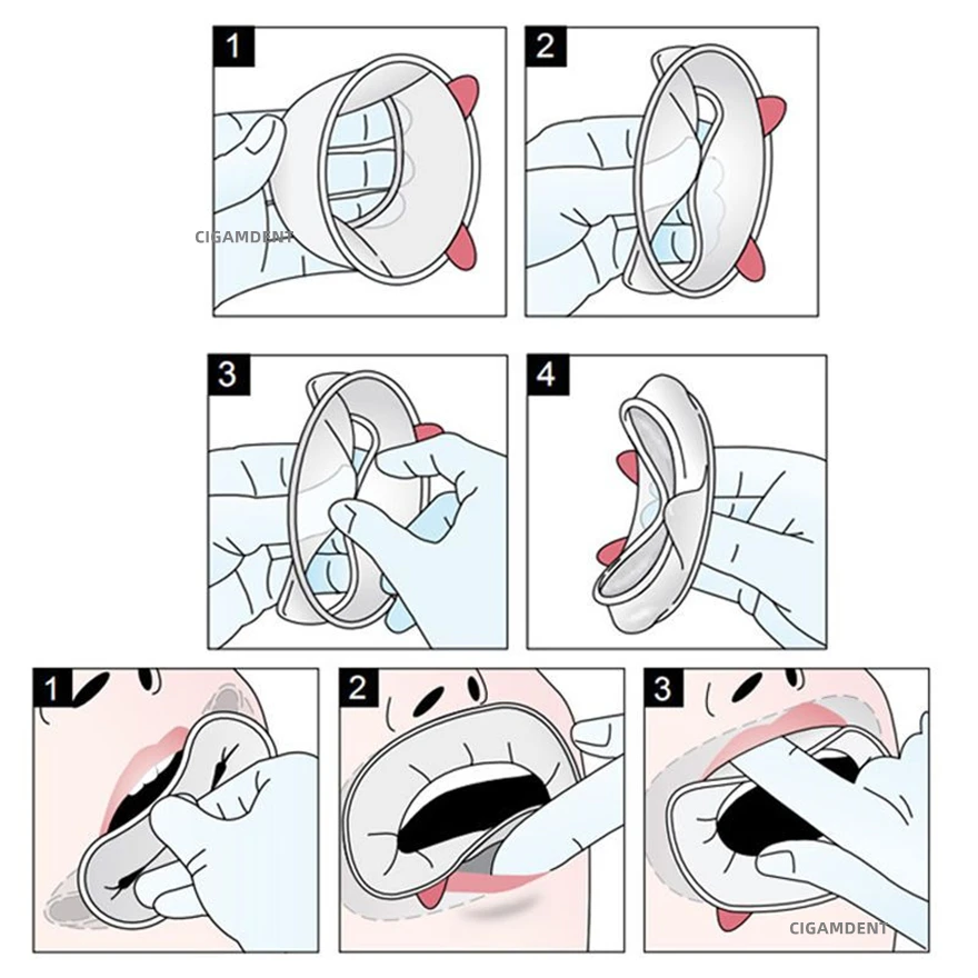 10 sztuk dentystycznych jednorazowego użytku 3D otwieracz do ust ustny policzek zwijacz gumowy zwijacz w kształcie otwieracz do ust