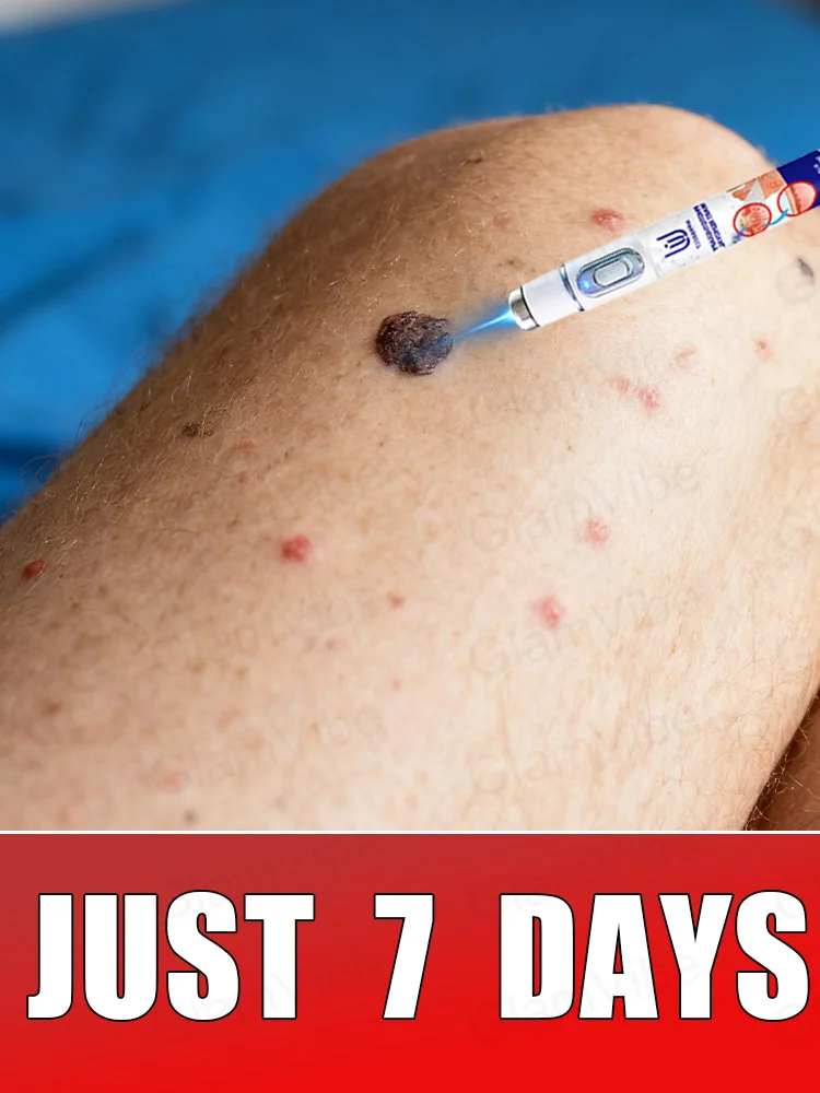 

2nd ᵍᵉⁿᵉʳᵃᵗⁱᵒⁿ ᵘᵖᵍʳᵃᵈᵉᵈ wᵃʳᵗ ⸴ ʳᵉpᵃⁱʳ wᵃʳᵗˢ ʳᵒoᵗ ⸴ ᑫᵘⁱᶜᵏˡʸ