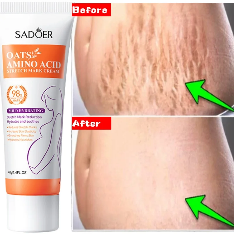 

Cream For Pregnancy Stretch Mark Removal Firm Obesity Lines Growth Lines Repair Cream Eliminate Red White Old Stretch Mark 2025