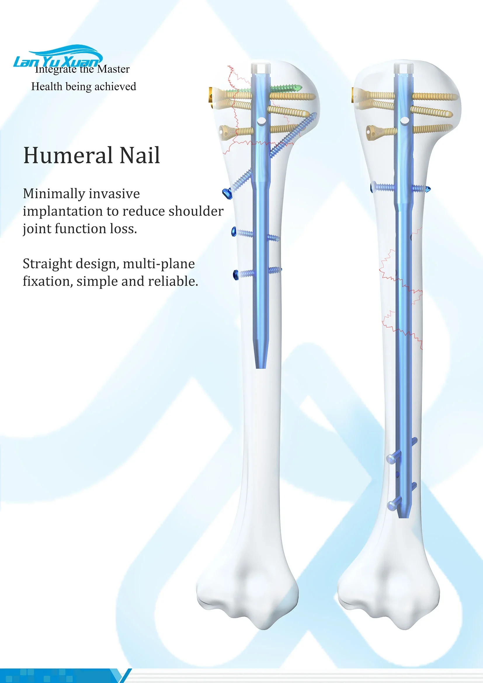 Multiloc Humeral Intramedullary Nail Interlocking Orthopedic Implants Titanium With Locking Screw