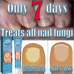 Nail Fungus Tool Included, Say Goodbye to Onychomycosis in 7 Days