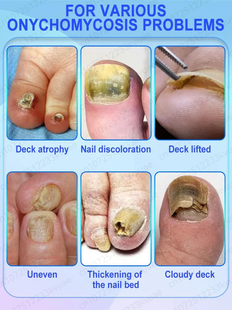 Nail fungus treatment essential oil, repair onychomycosis in 7 days