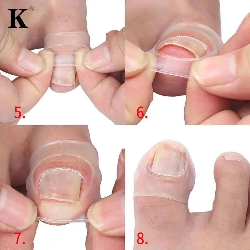 1pair Silicone Ingrown Toenail Correction Tool Invisible Ingrown Toe Nail Treatment Elastic Straighten Clip Brace Pedicure Tool