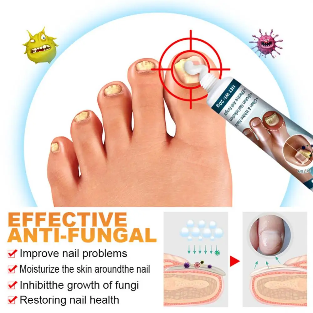 Nail Repair Lotion Kill Deep Fungal Toe Nail Cream Multifunction Nail Care Gray Nail Cream Onychomycosis Removal Beauty