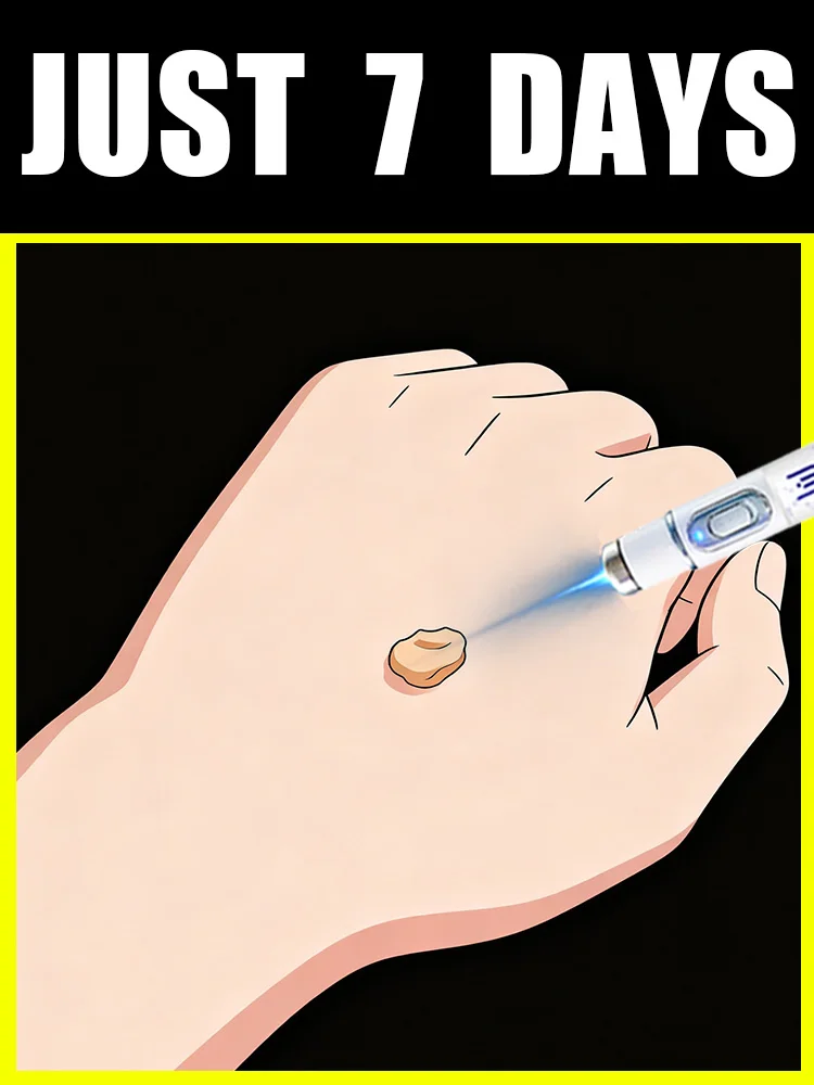 

XUización de herramienta для излучения verrugas con Vissuer azul