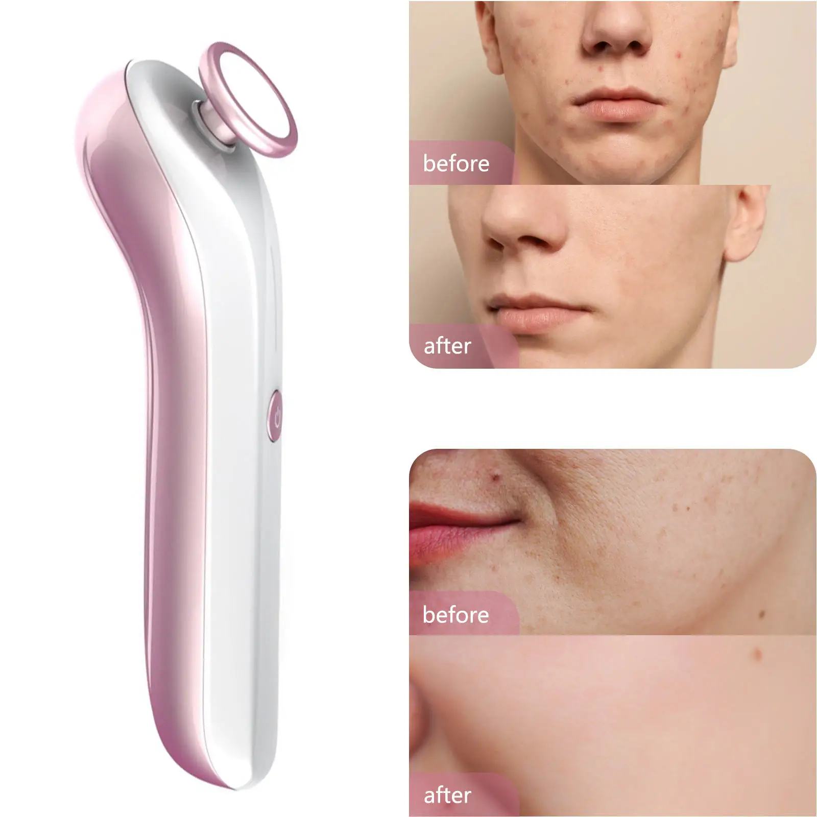 جهاز علاج الأوزون بالبلازما الفولاذي لإزالة ندبات حب الشباب وعلاج تبييض البشرة لمنتجعات الجسم