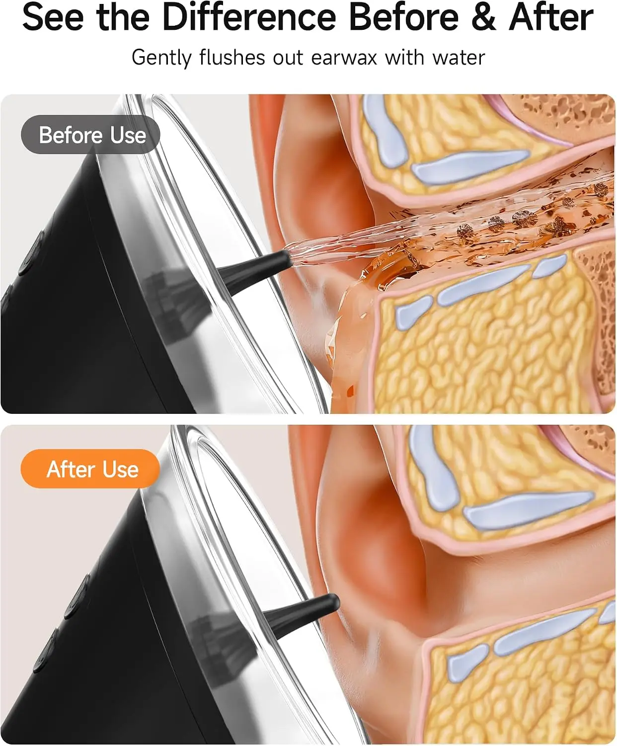 Ear Wax Removal Kit, Manual Ear Irrigation Flushing System, Safe Effective Ear Cleaner Ear Cleaning Kit for Adults Kids Home Ear