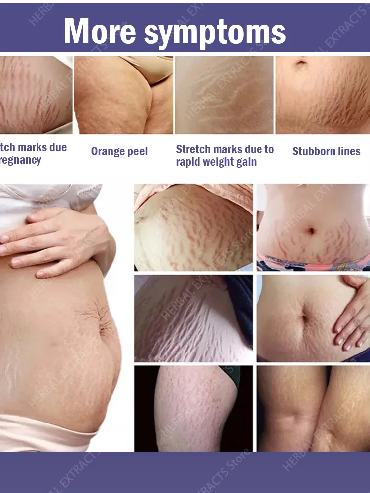 Eliminate Old Stretch Marks Cream For Pregnancy