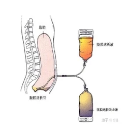 Full-automatic peritoneal dialysis machine peritoneal dialysis pipeline dialysate renal failure renal dialysis treatment