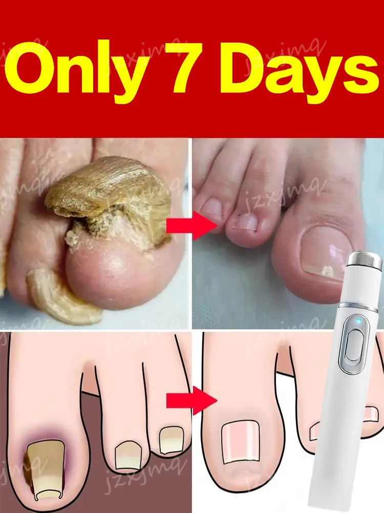 Fungal Nail Laser Device Repair Fast Nails Fungus Onychomycosis