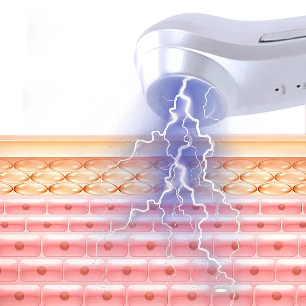 Massageador facial de plasma tratamentos cicatriz máquina de remoção de acne anti rugas dispositivo de beleza para pescoço rosto melhora o tom da pele