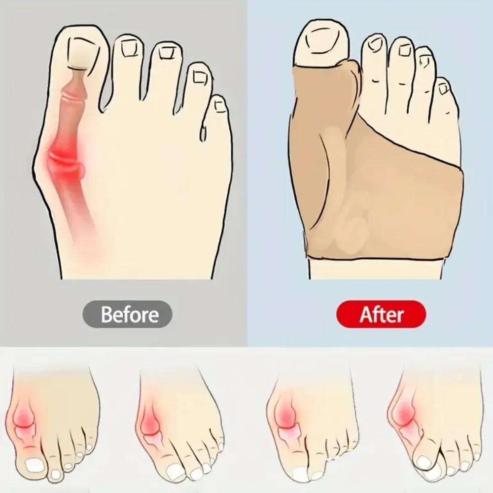 1 Pair of Soft Feet Covers: Big Toe Splitter, Hallux Valgus Corrector Palm Covers for Maximum Comfort image 6