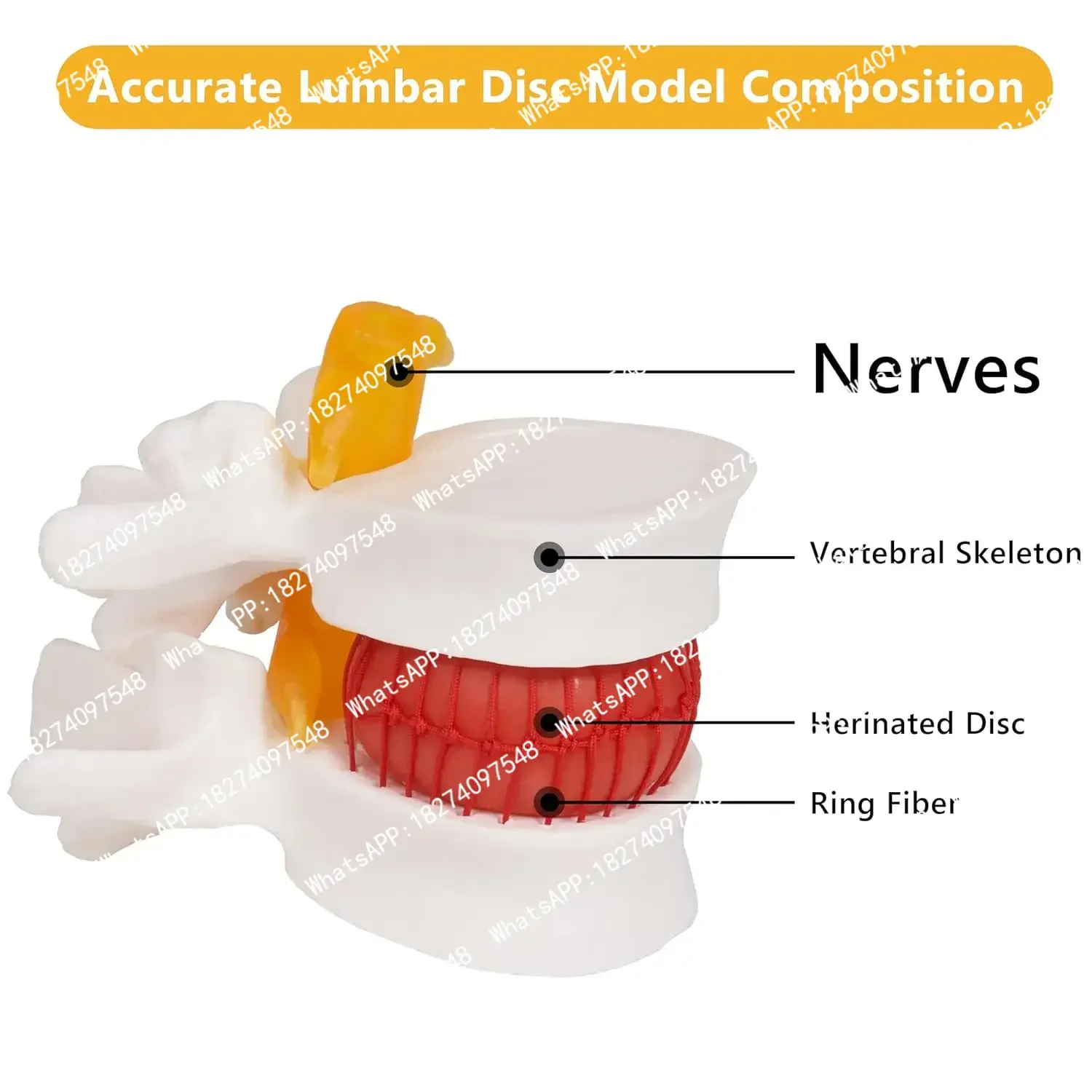 1.5X Human Anatomical Lumbar Disc Herniation Model, Movable Human Lumbar Disc Herniation Model Teach Demonstrating Tool