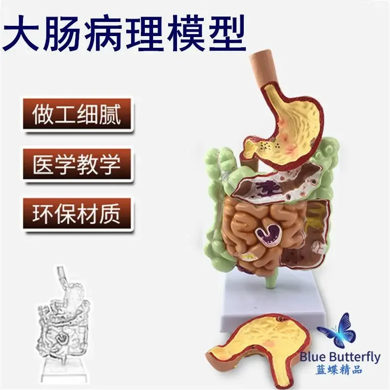 نموذج المعدة المرضية نموذج المعدة المرضية علم الجهاز الهضمي القسم التاوي التوسع التشريحي