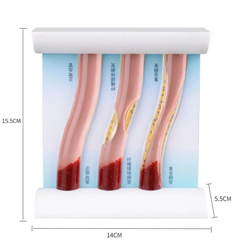 Three-Vessel Vascular Model: Healthy Artery and LDL-Induced Blockage Simulation