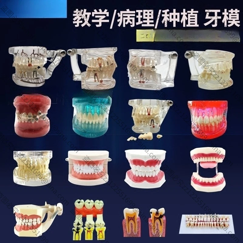 Suitable for Teaching Model Detachable Teaching Ready Denture Model Ornament