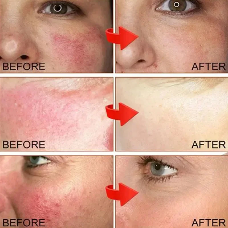 B5 إصلاح احمرار الوجه كريم لحظة العنكبوت الوريد إزالة الجلد الحساسة تهدئة مكافحة احمرار Rosacea علاج غسول مستحضرات التجميل الكورية #2