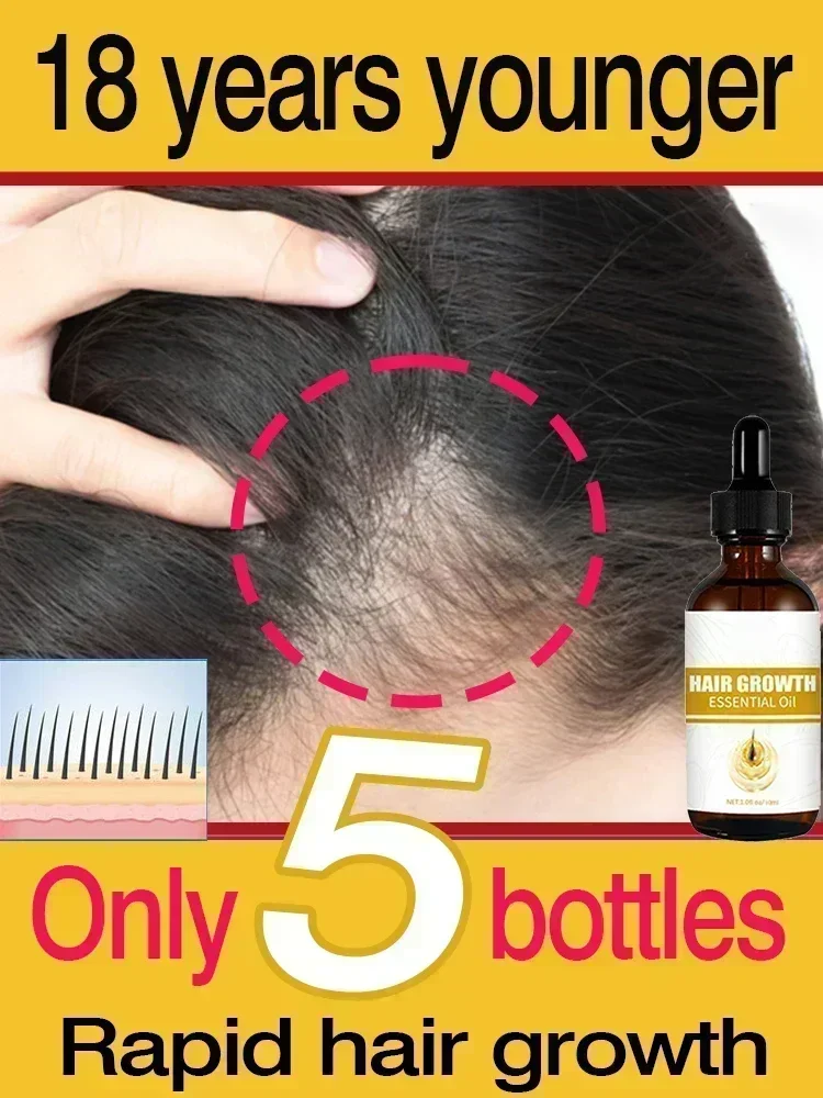 Gran oferta, crecimiento rápido del cabello, reparación de calvicie, hereditario seborreico para hombres y mujeres