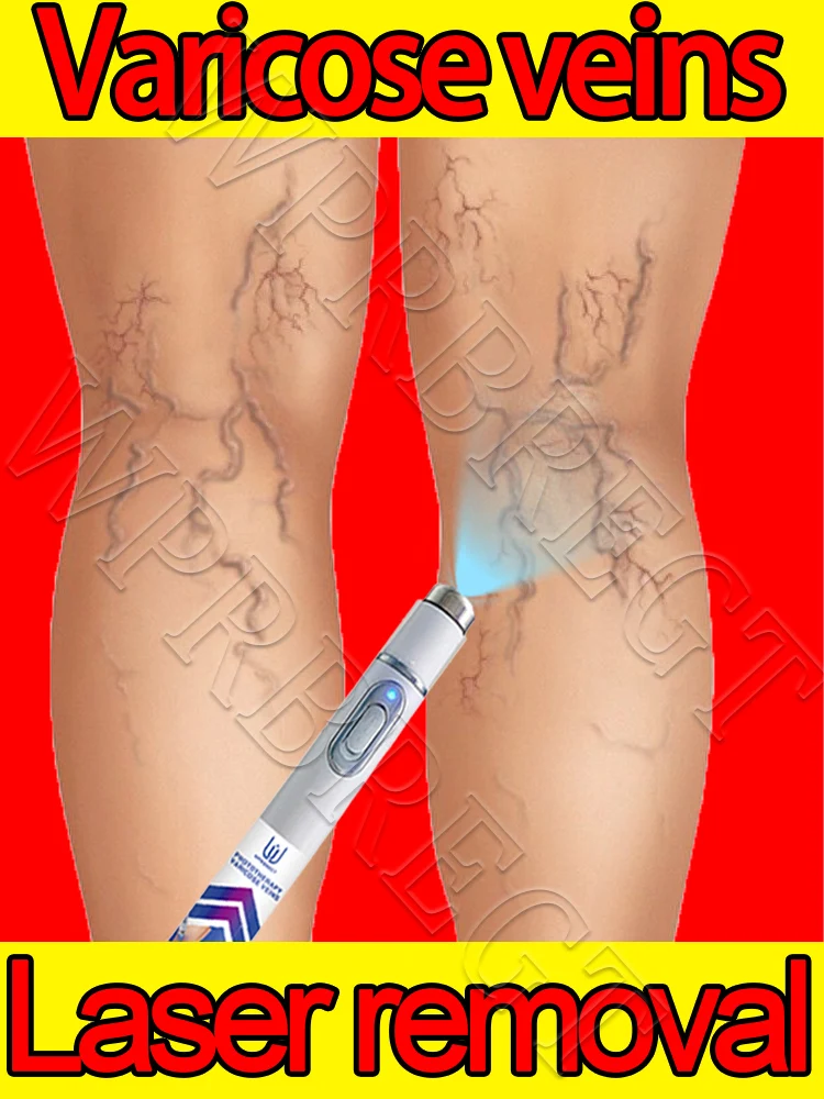 

Generation 2: Varicose vein laser eliminates vasculitis and thrombophlebitis, relieves spider leg pain, laser treatment pointers
