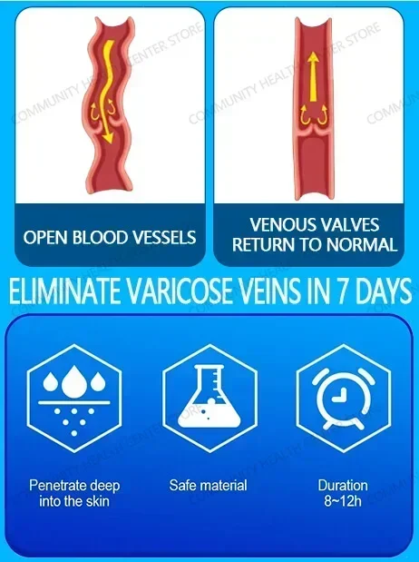 Vena laser |   esercizi sulle vene |   trainer delle vene |   esercizi per le mani delle vene
