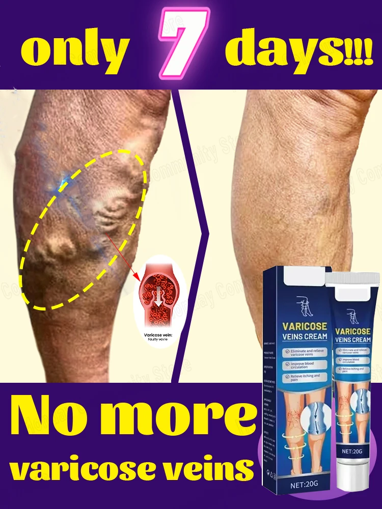 

Varicose Vein Repair Tongmai Effective Relieves Leg Bulge Pain Treatment Vasculitis Phlebitis Remove Vein New