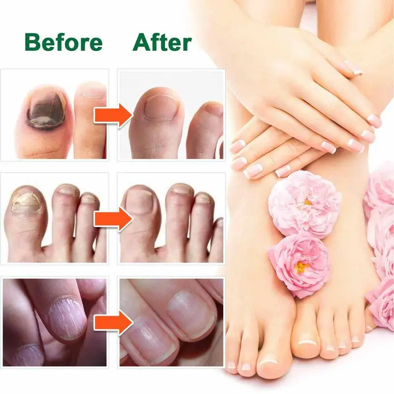 Essência do reparo do prego para o cuidado do toenail, solução para reparar o molde danificado, quebrado rachado, soro descolorido das unhas, essência natural, correção