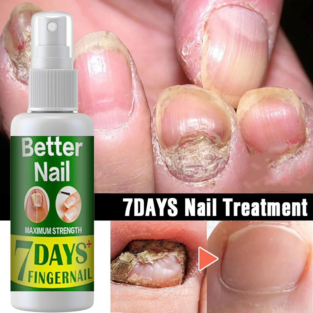 

Fungal Nail Repair Spray Nursing Treatment Foot Nail Fungus Removal Gel Anti-Infective Paronychia Onychomycosis Care