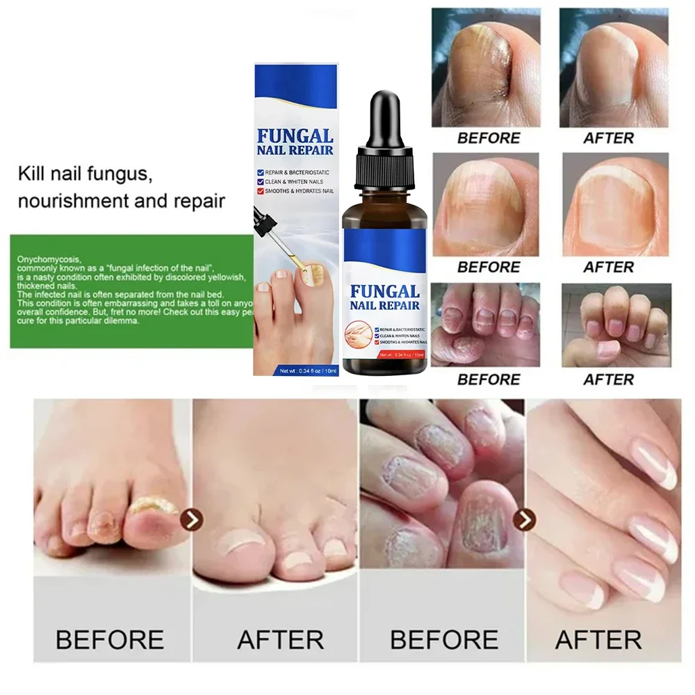 Fungal Nail Treatment Ingrown Toenail Repair Nail Fungus Treatment Liquid  Anti Paronychia Relief Oil Stop Pain