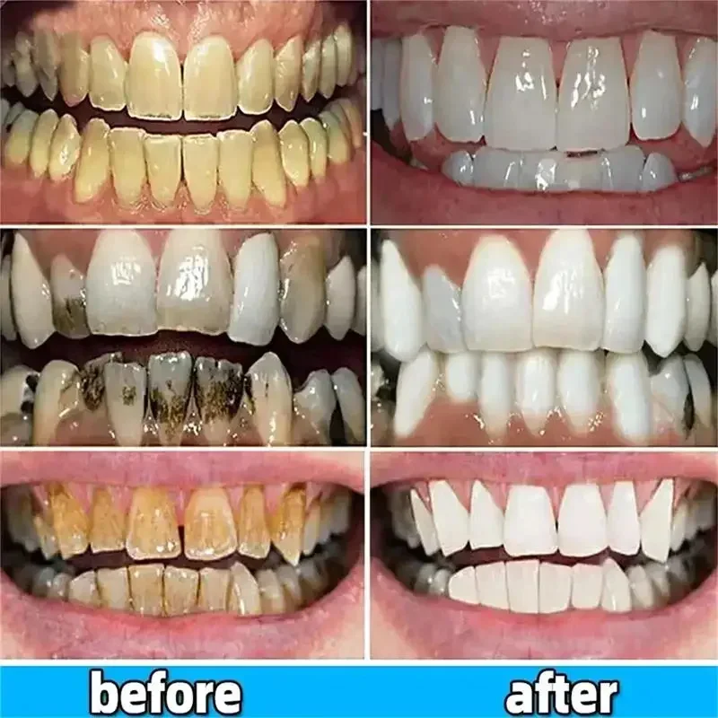 5D Whitening Teeth Stickers Gel Whitening Strips Stain Removal Oral Hygiene Care Strip Dental Bleaching Clean Oral Hygiene Teeth