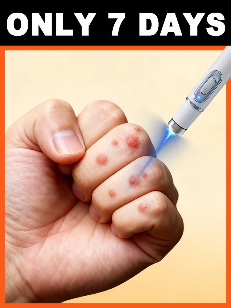 

Just point the laser pen at the wart, ⁿᵒ ᶜᵒᵐᵖˡⁱᶜᵃᵗᵉᵈ ˢᵗᵉᵖˢ ʳᵉᑫᵘⁱʳᵉᵈ⸴ ˢᵘᵖᵉʳ ʷᵒʳʳʸ⁻ᶠʳᵉᵉ