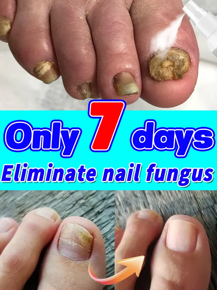 Las uñas pasan de estar opacas a transparentes. El spray para hongos en las uñas es testigo del milagro.