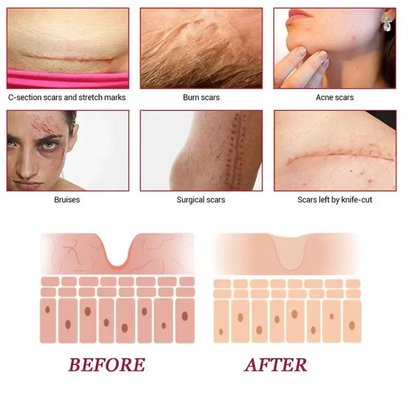 Scar cream gel effective repair surgical scars stretch marks acne pits pockmarks burn scars repair treatment