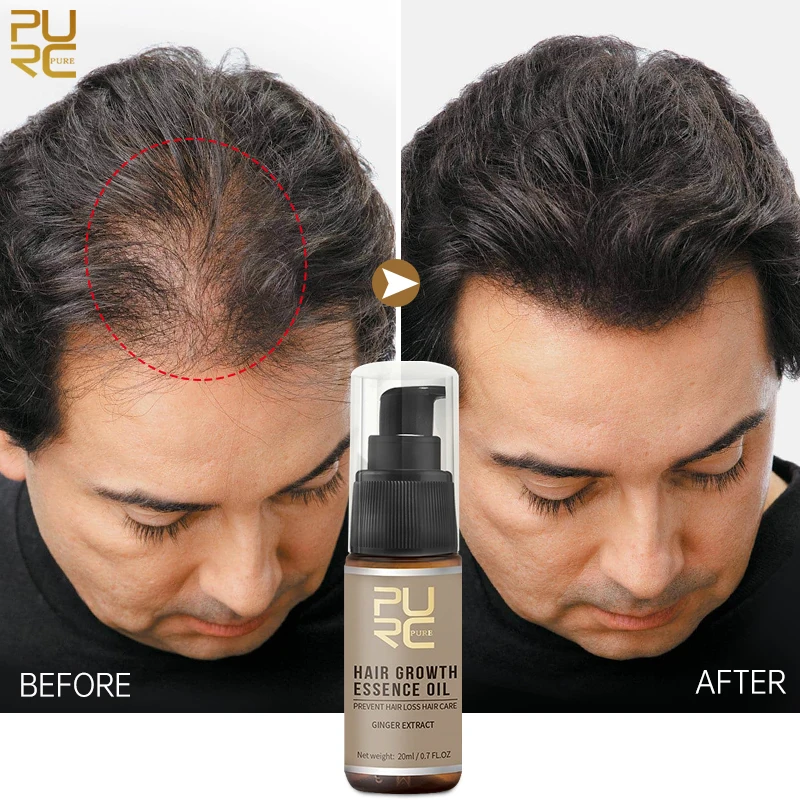 

PURC Ginger Hair Growth Oil for Hair Loss Treatment Fast Regrowth Thicken Nourish Root Care Hair Growth Products For Men Women