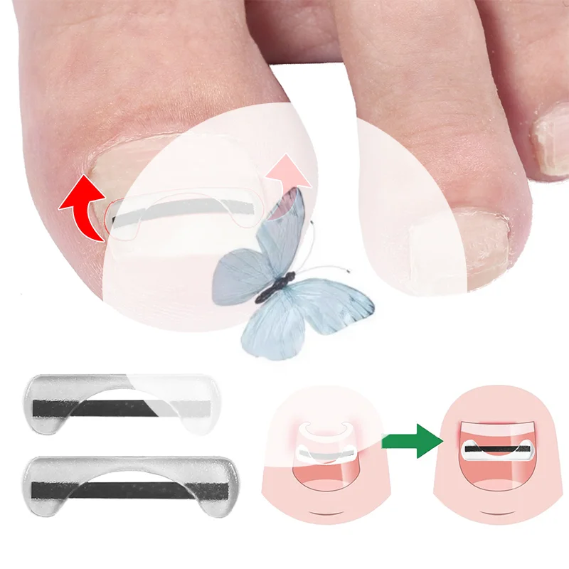チタン合金足の爪矯正ワイヤー陥入爪治療装置ステッカーシリコーンツールフットケアアクセサリー日常使用