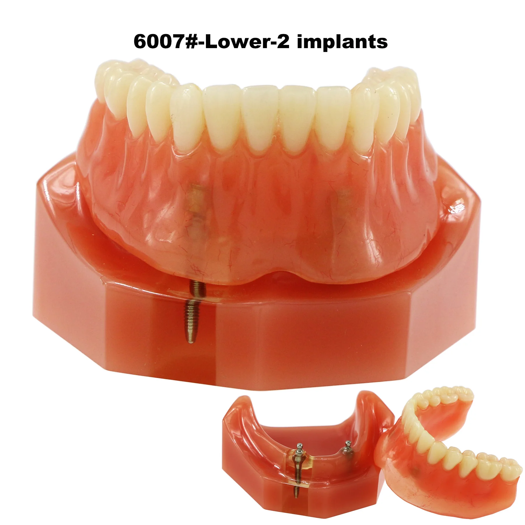 

Dental Implant Teeth Model M6007 Typodont Overdenture 2 Implants Inferior Lower Restoration Treatment Demo For Study Teach