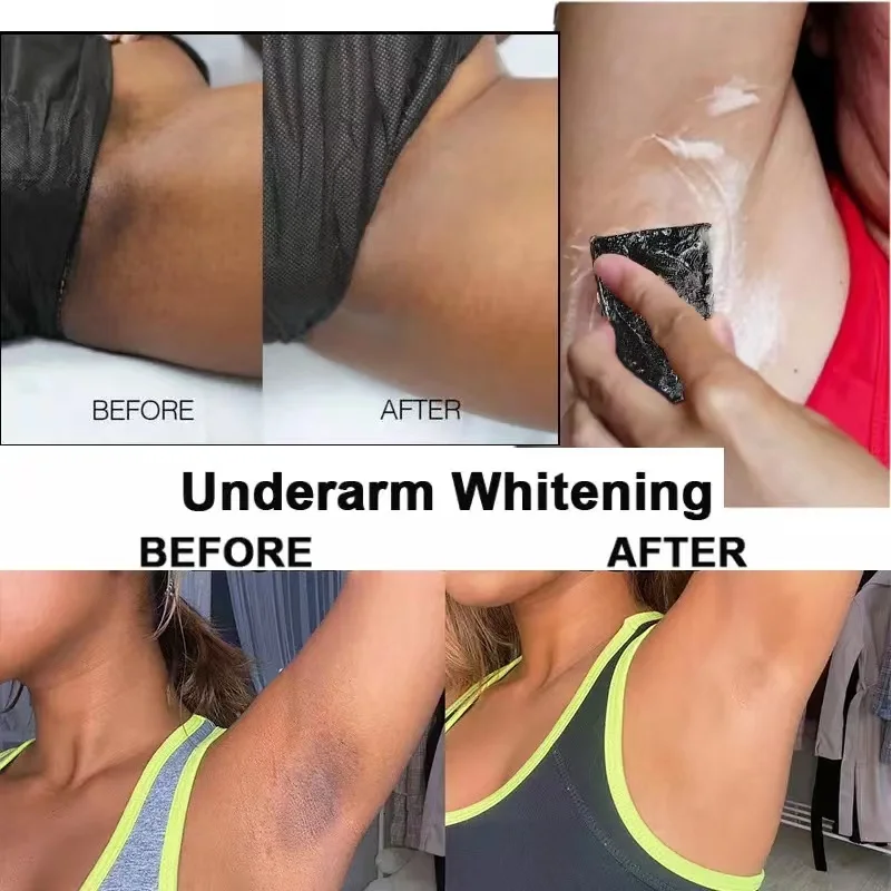 

Natural Whitening Ingredients Is Aimed At Whitening Dark Skin Correcting Removing Dark Spots Facial Pigmentation Chloasma