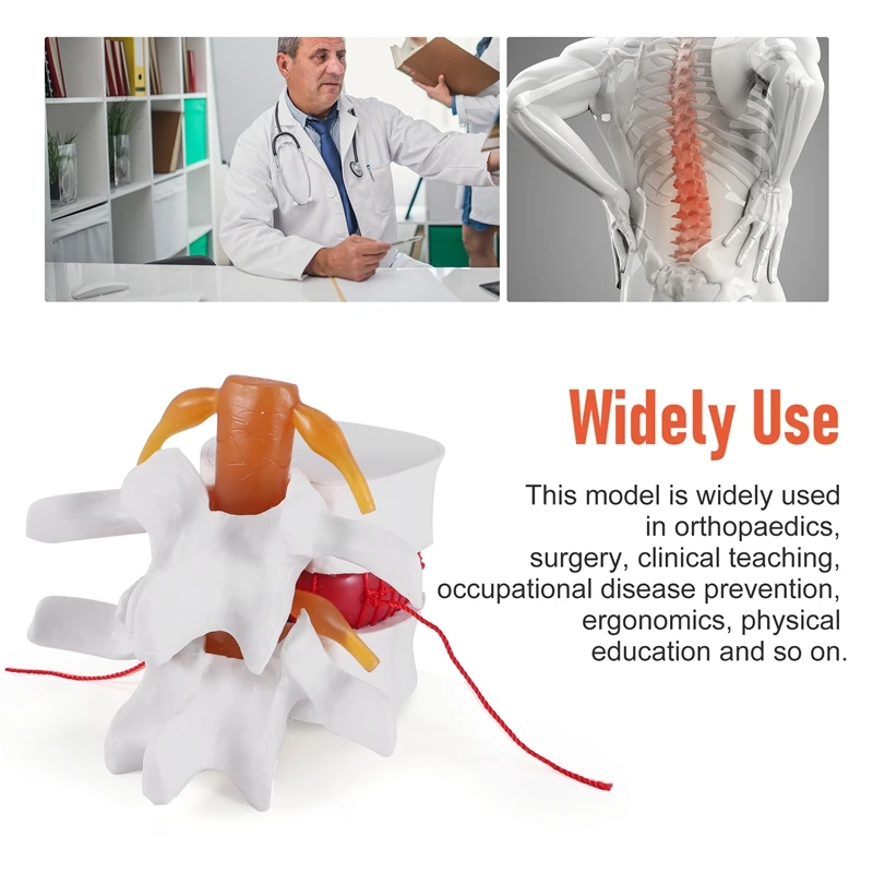 Top-1:1.5 نموذج عرض فتق القرص القطني البشري لنموذج العمود الفقري القطني للتشريح البشري