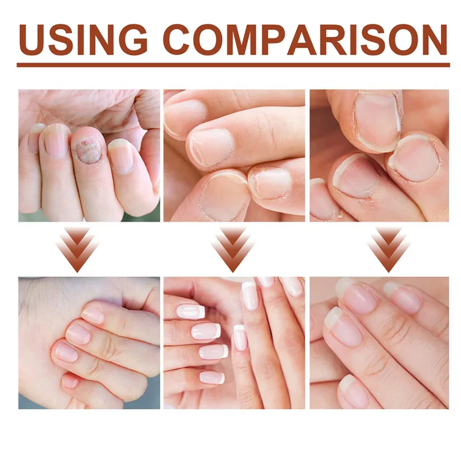 Yiganerjing-fórmula de queratina para uñas, 2 piezas, aminoácidos, elimina la queratina, crecimiento de 3 días, Peeling y Chipping, reparador de uñas, 15ml