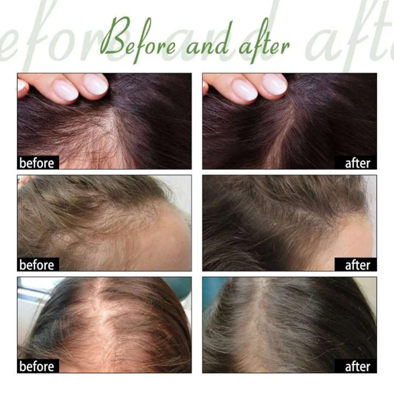 Suero rápido para el crecimiento del cabello, aceite para Barba axilar y pecho, líquido para el crecimiento del cabello más largo y grueso, previene la alopecia, anticaída del cabello