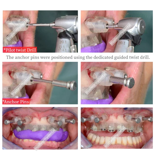 Imagen 2 del producto Φ1.5x20 Pin de anclaje guiado Dental taladro helicoidal guiado eje largo y corto Kit de pasadores de fijación de plantilla de pasador de fijación de implante guiado