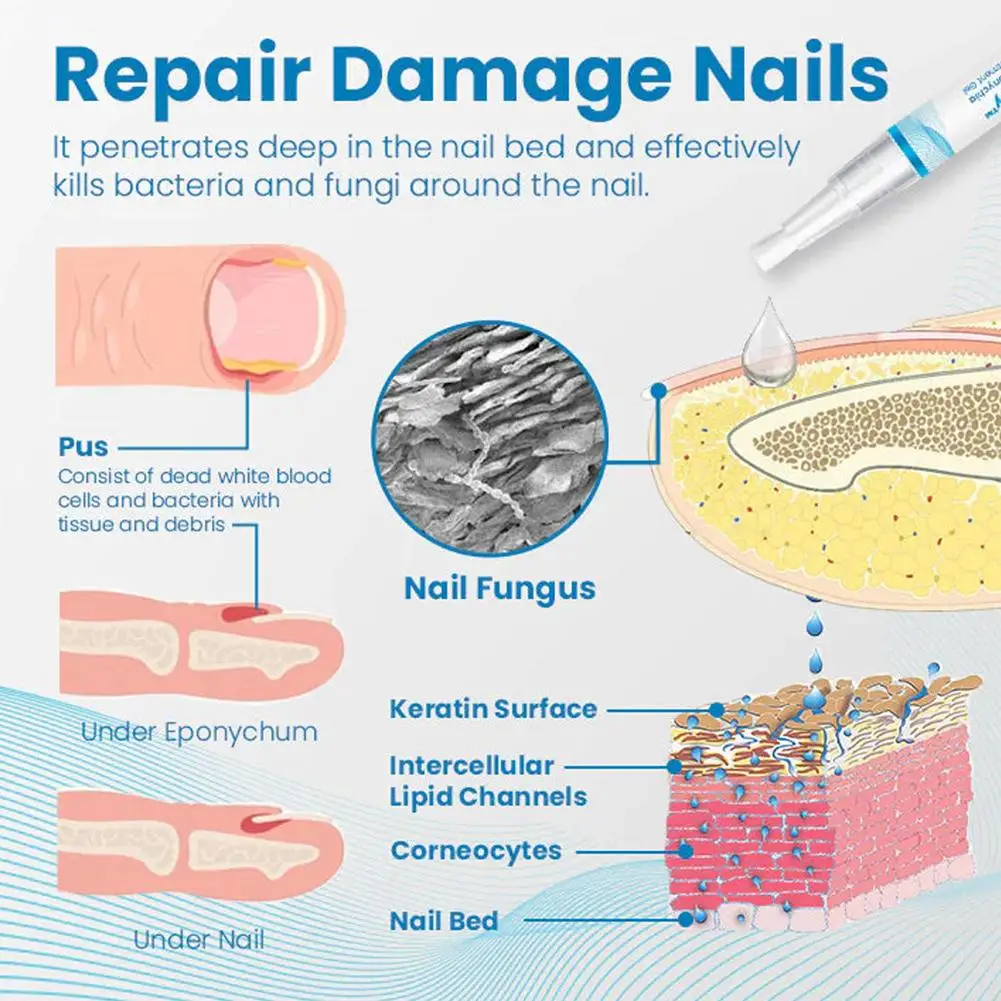 Nail Toenails Nail Repair Pen Anti Care Repair Serum Painless Nail Health For Thicked Broken Discolored Nails R1M3