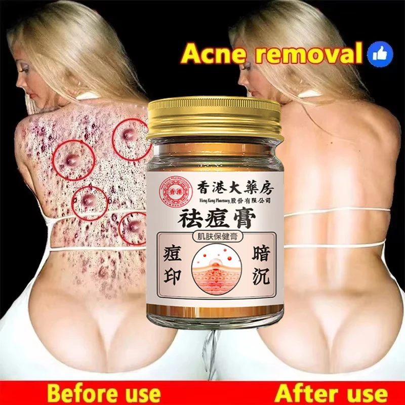 Crema para eliminar el acné corporal, tratamiento facial, trasero, marcas de acné, reparación suave, crema para la piel de pollo, blanqueamiento hidratante, cuidado de la piel