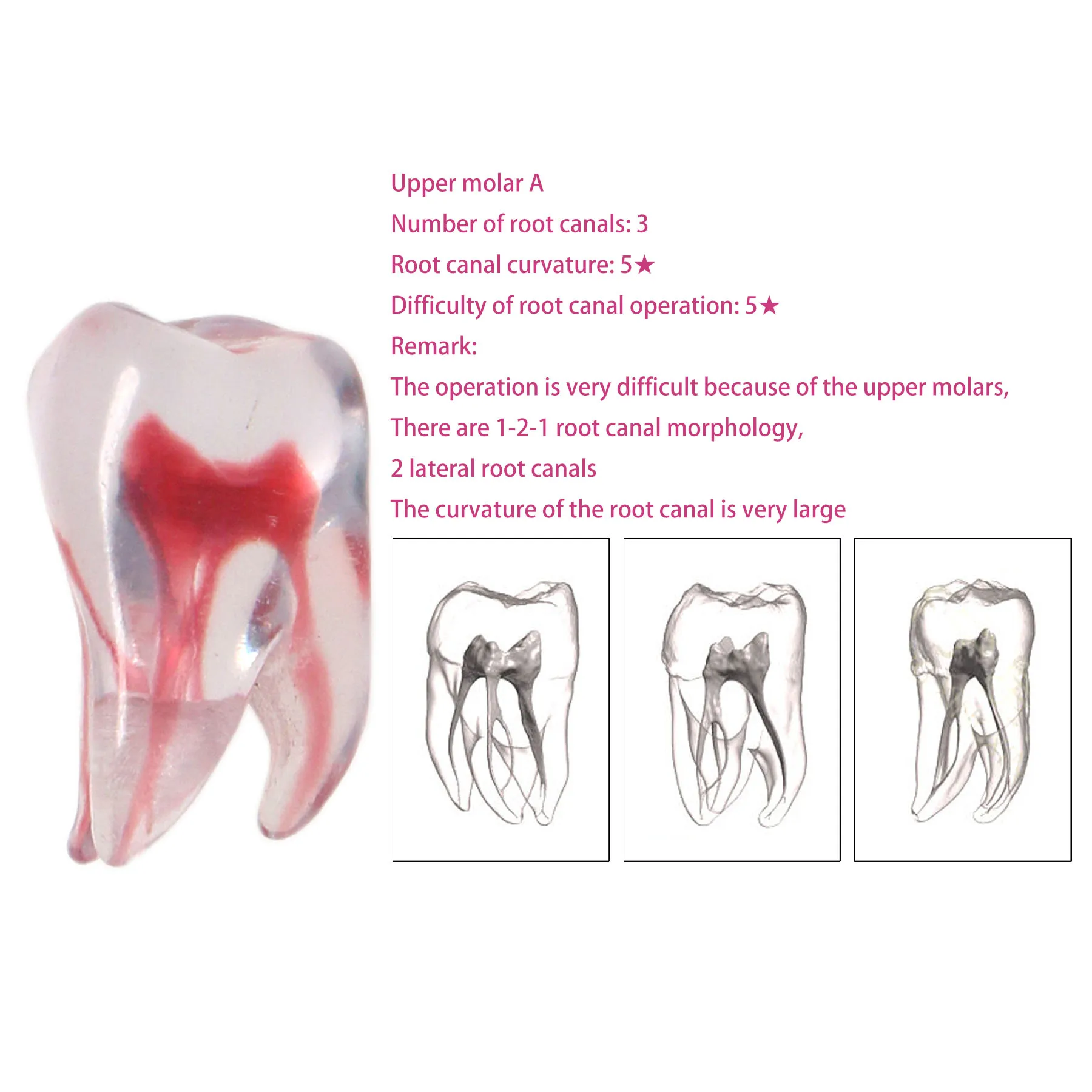 

Upper Molar A 1PC Dental Root Canal 3D Model Practice Model Root Canal Therapy Resin Model Endodontics RTC